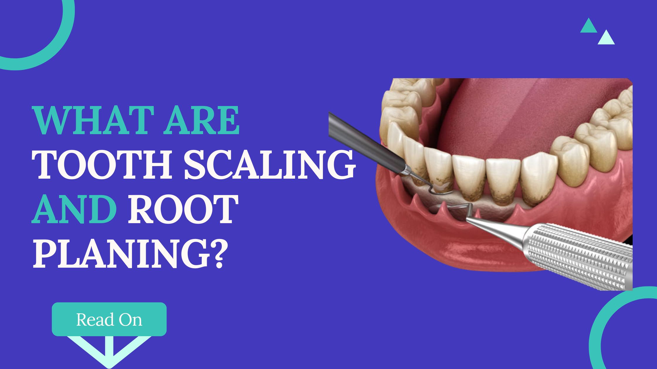 What Are Tooth Scaling And Root Planing? - DDH Dental Clinic